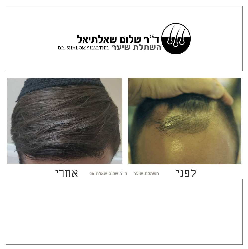 חושב על השתלת שיער? ד"ר שלום שאלתיאל מסביר מדוע כדאי לבצע השתלה רק בישראל