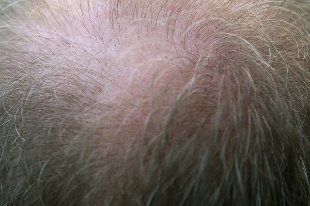 השתלת השיער אצל גברים: טכנולוגיה מתקדמת בהשתלות שיער